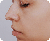 تزریق فیلر بینی جهت اصلاح فرم - قبل از درمان