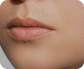 تزریق فیلر لب متد روسی - قبل از درمان