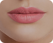 تزریق فیلر لب متد روسی - بعد از درمان