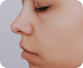 تزریق فیلر بینی جهت اصلاح فرم - بعد از درمان